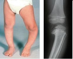درمان پای پرانتزی در کودکان و بزرگسالان-pic1