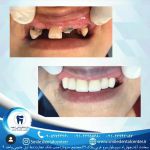 کلینیک دندانپزشکی لبخند،جراحی ایمپلنت پی-pic1