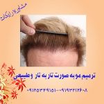 ترمیم موی موتاب  ( بدون جراحی )-pic1