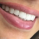 دندان مصنوعی و پارسیل تیکه ای-pic1